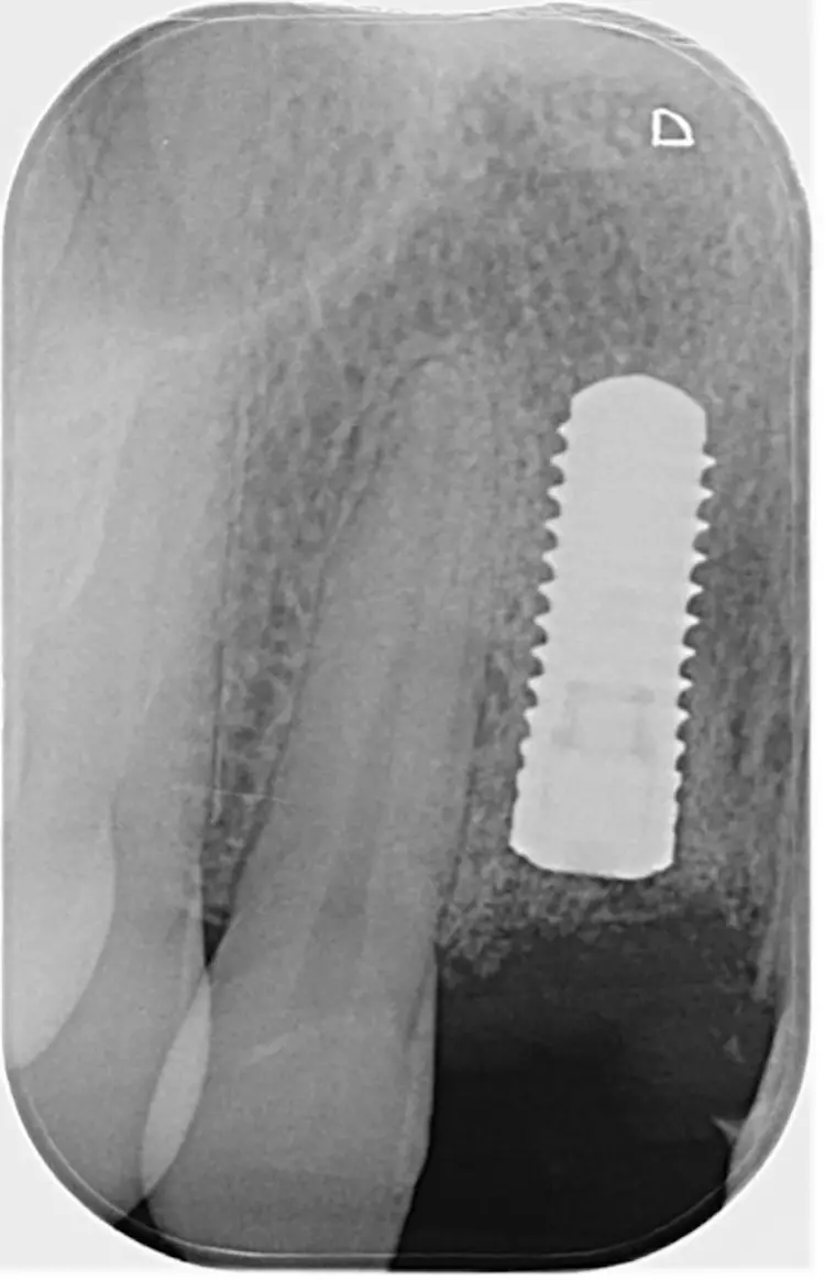 Abb. 14: Kontrollaufnahme regio 11
post implantationem.