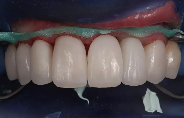 Abb. 14: Eingesetzte Full-Veneers/Hybridkronen Creapresskäppchen (Creapress
KLEMA) mit Feldspatkeramikverblendung (Creation CC, KLEMA, Österreich) 13
bis 23. Ausgeformtes Weichgewebeprofil Einzelzahnimplantat 022 als Grundlage
für die Herstellung der definitiven Implantateinzelkrone (Titanabutment, A3 Dental)
mit Creapresskäppchen (Creapress KLEMA) und Feldspatkeramikverblendung
(Creation CC, KLEMA, Österreich).