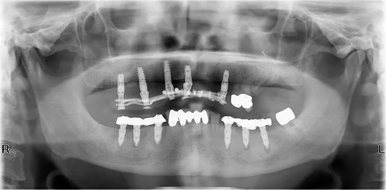 Abschlussröntgenbild nach Einsetzen des Gerüstes.