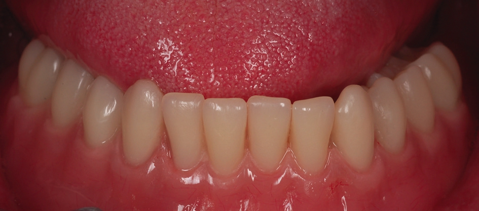 Abb. 15: Definitive Prothese auf PS Easy-Con Abutments in situ.