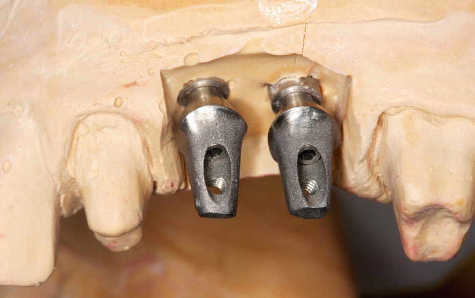 Abb. 14: Definitive Aufbauten auf dem Meistermodell.