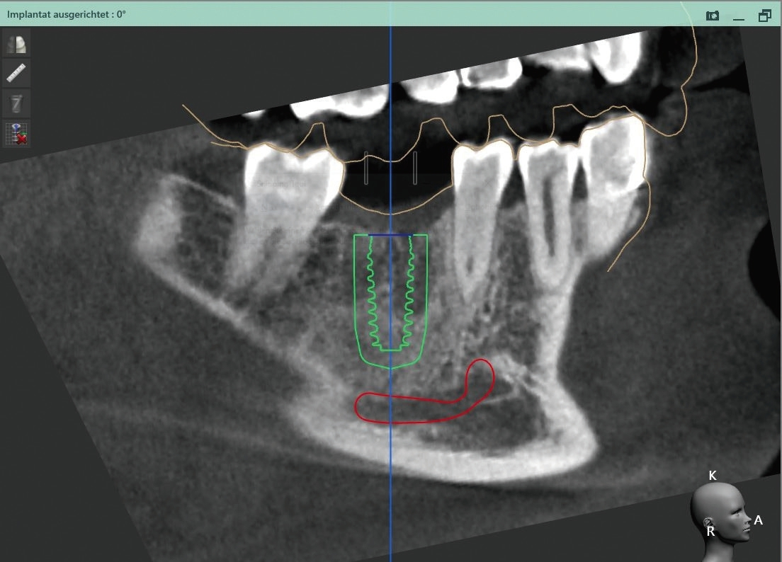 Abb. 14: Festlegen der Implantatposition unter Berücksichtigung des Knochens und des Mandibularkanals.