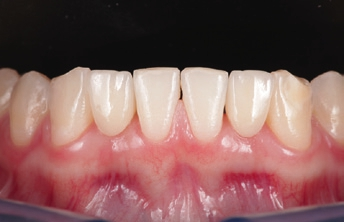 Abb. 14: Ergebnis von frontal im Detail.
