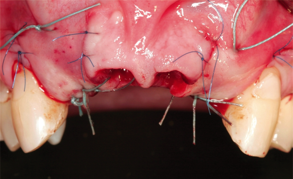 Abb. 13: Spannungsfreie Nähte und apikale Matratzennaht um Spannung der Lippe zu reduzieren.