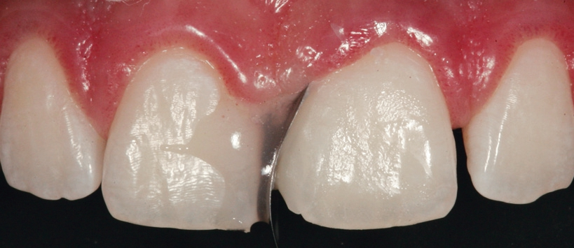 Abb. 14: Überschichtung dieser Zahnschmelzlamelle nach labial mit der Dentinmasse.