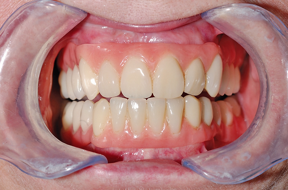 Abb. 13a: Die Prothesen in Funktion, Ansicht in Protrusion.