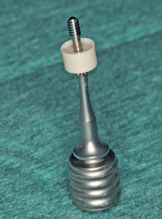 Abb. 14: Ein 4 mm hoher Gingivaformer wurde in dem Implantat verschraubt.