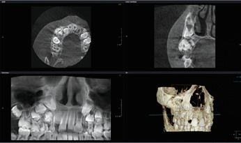 Abb. 17: MPR Ansicht DVT, komplexes Odontom.