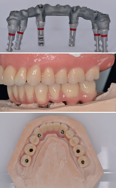 Abb. 13a-c: Das Straumann Pro Arch-Konzept ermöglicht es oft, eine Augmentation zu umgehen. Es wird derzeit wissenschaftlich begleitet.