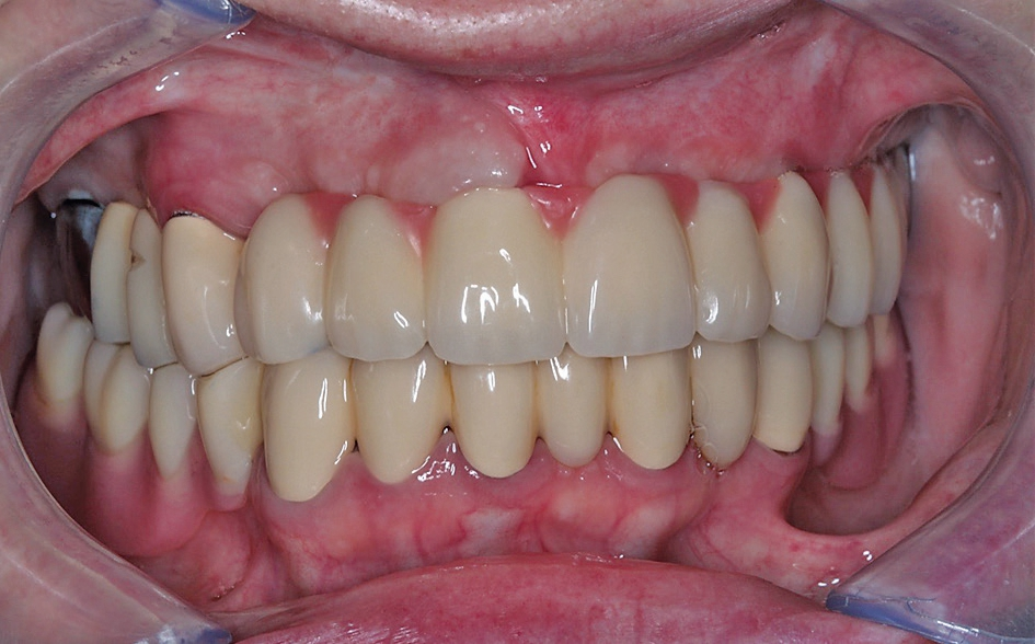 Abb. 51: 6 Monate nach Augmentation, 3 Monate nach Implantation.