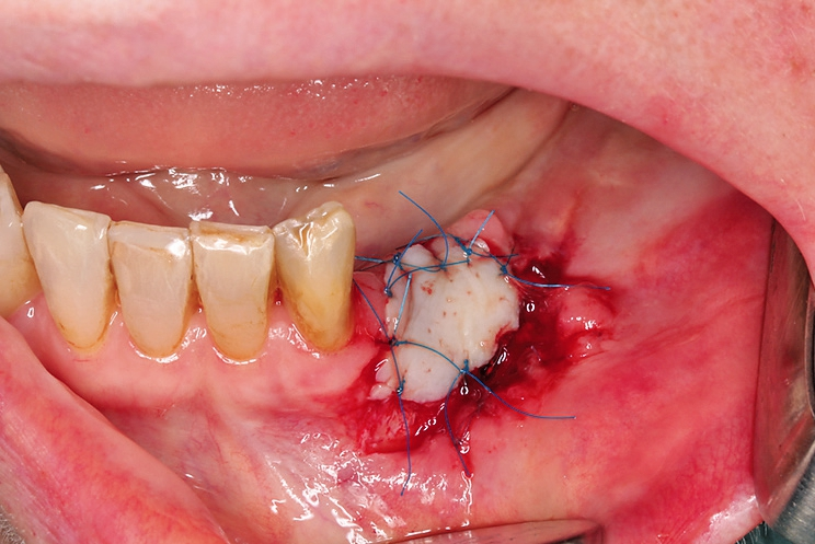 Abb. 14: Freiliegendes Gitter wird mit freiem Schleimhauttransplantat aus dem Gaumen gedeckt.