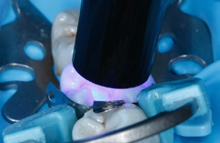 Abb. 14: Lichtpolymerisation des Füllungsmaterials für 20 Sekunden.