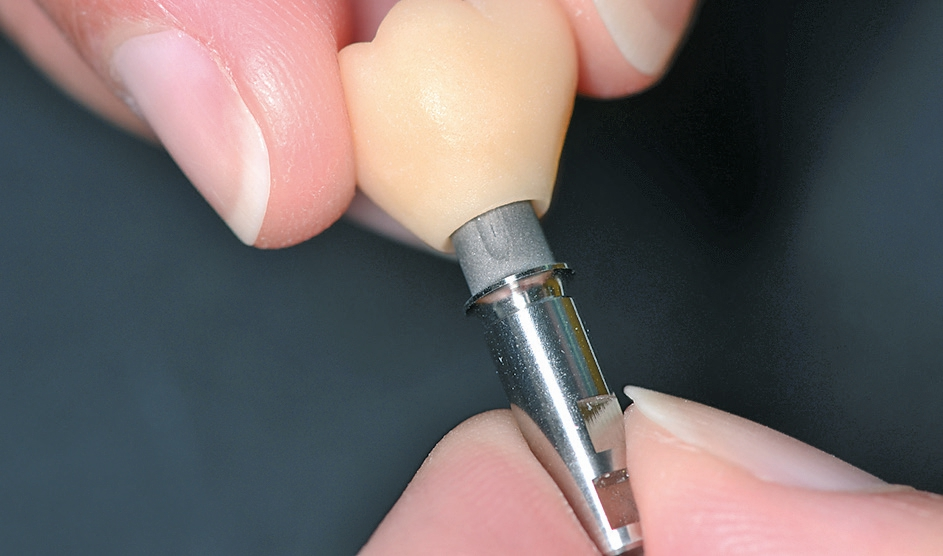 Abb. 13: Aufpassen der keramischen Krone auf die Viteo Base.