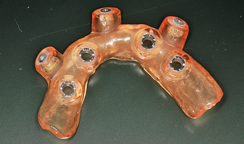 Abb. 14: Bohrschablone für den Unterkiefer.