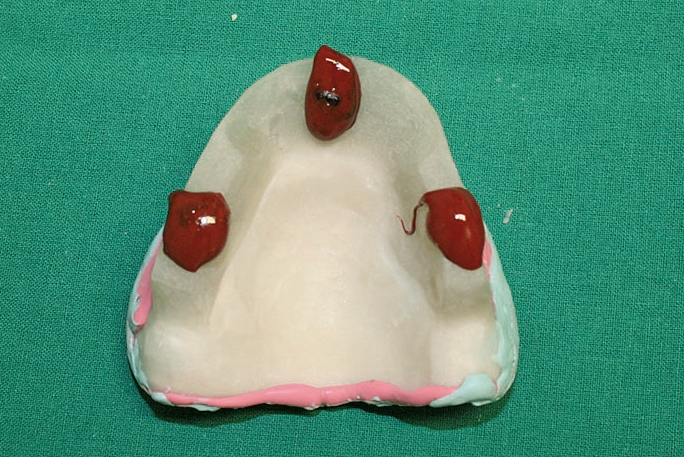 Abb. 9: Vorbereitung für die Vorzentrik.