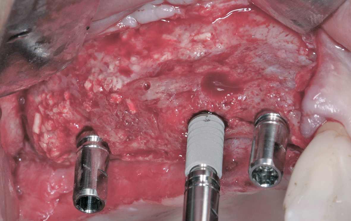 Abb. 14: Die Insertion der ANKYLOS Implantate.