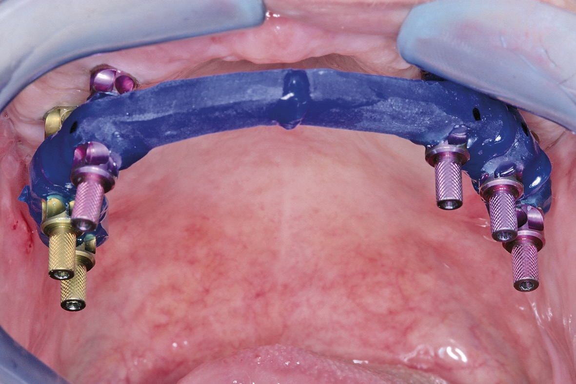 Abb. 13: Die zweite Sekundärabformung wird über eine offene Abformung mittels individuellen Löffels genommen. Es erfolgt zudem eine interne Verblockung, die intraoral durch das Wiederverbinden der zuvor im Labor getrennten Elemente erreicht wird.