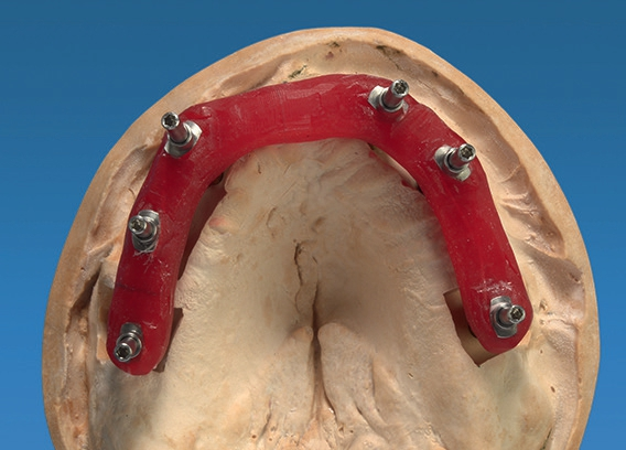 Abb. 14: Ausgleich der Divergenz und der subgingivalen Situation mit gewinkelten Multi-Unit-Abutments.