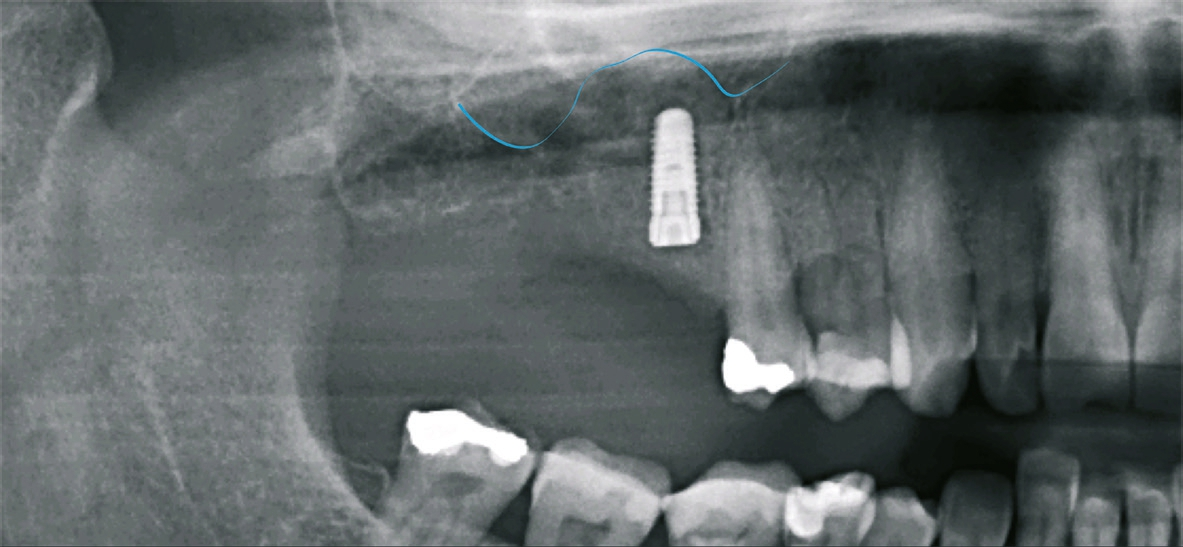 Abb. 14: Nach Implantation in regio 16.