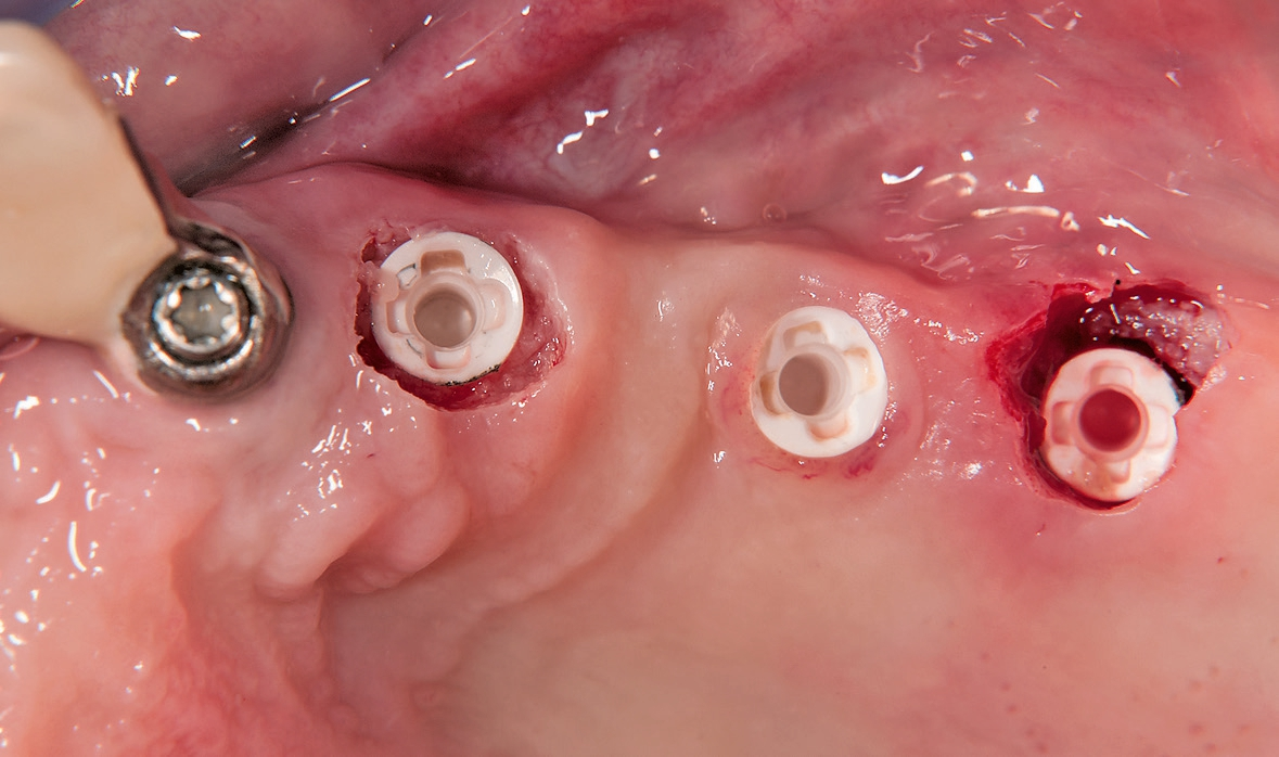 Abb. 14: Freigelegte Implantate.