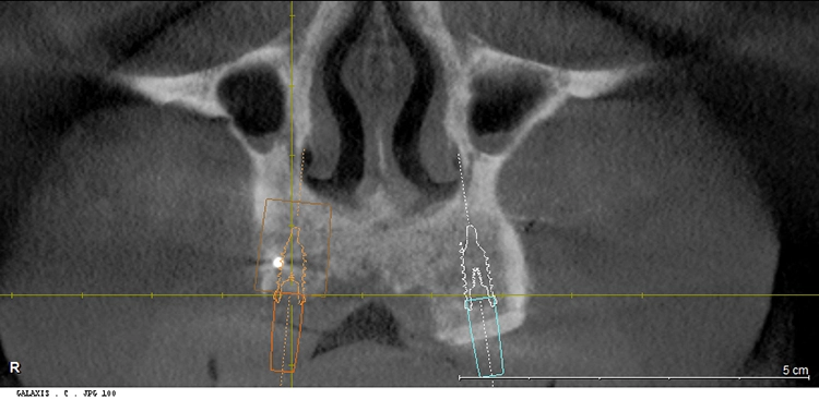 Abb. 14: DVT nach Augmentation.