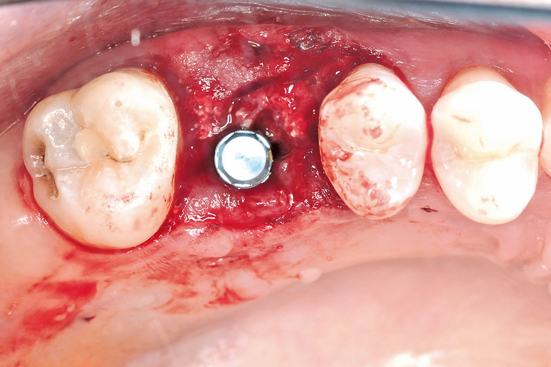 Abb. 14: Inseriertes Implantat (Straumann® Bone Level Tapered, Institute Straumann AG, Basel, Schweiz).