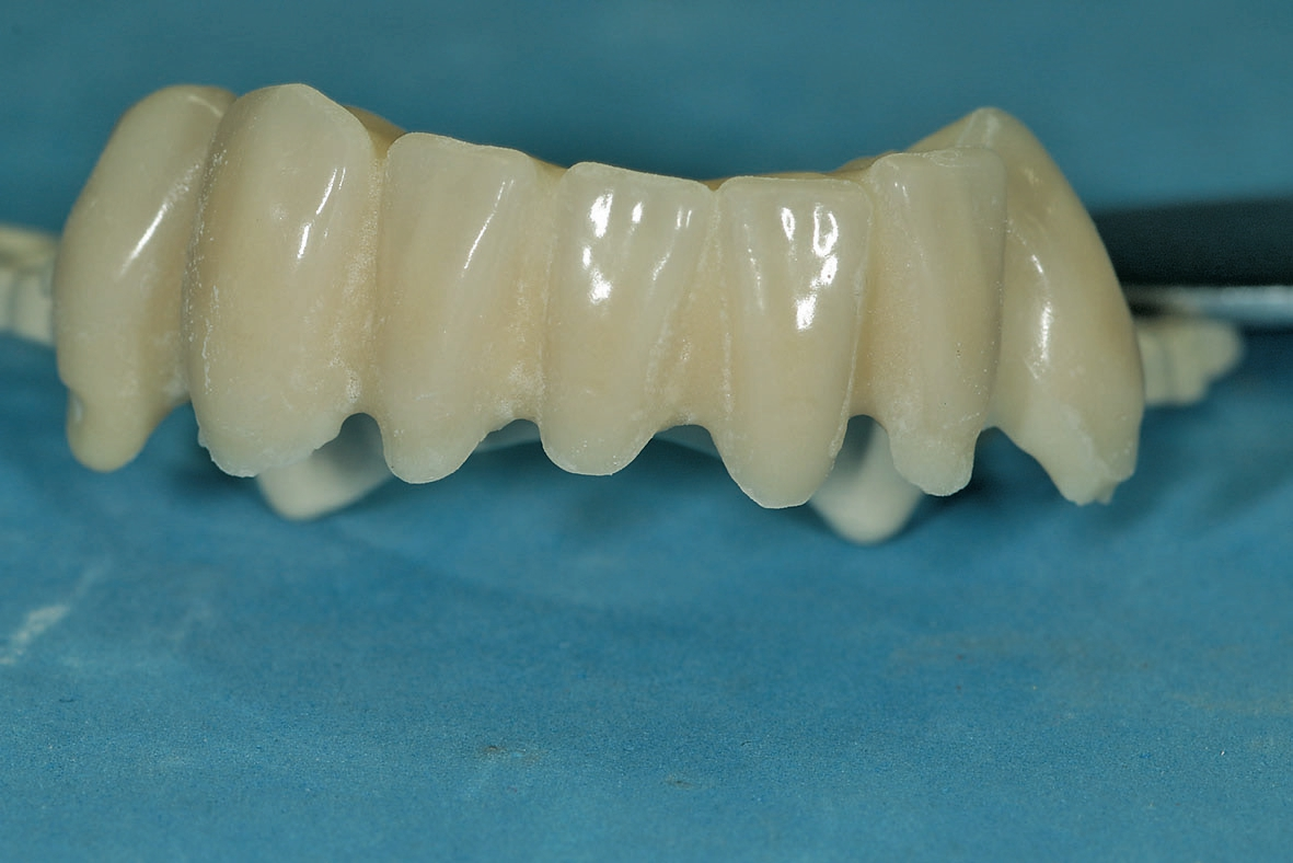 Abb. 17: Die UK-Frontbrücke mit aufgebrachten Verblendschalen, die mittels Heißpolymerisat (Biodent K+B Plus, Dentsply Sirona, Salzburg) befestigt wurden. Alternativ bieten sich auch Befestigungskomposite an. Die Auswahl ist jedoch nicht einfach – die Ergebnisse sind laut Rzanny et al. [4] unterschiedlich.
