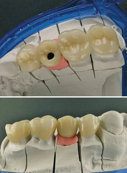 Abb. 40 u. 41: Die Versorgung der Implantatkrone des Zahnes 25 besteht wie in Region 36 und 37 aus einem individuellen Titanabutment, kompositverblendet. Die natürlichen Zähne 24, 26 und 27 wurden substanzschonend mit monolithischen Presskeramikkronen überkront (IPS E.max Press/Ivoclar Vivadent).