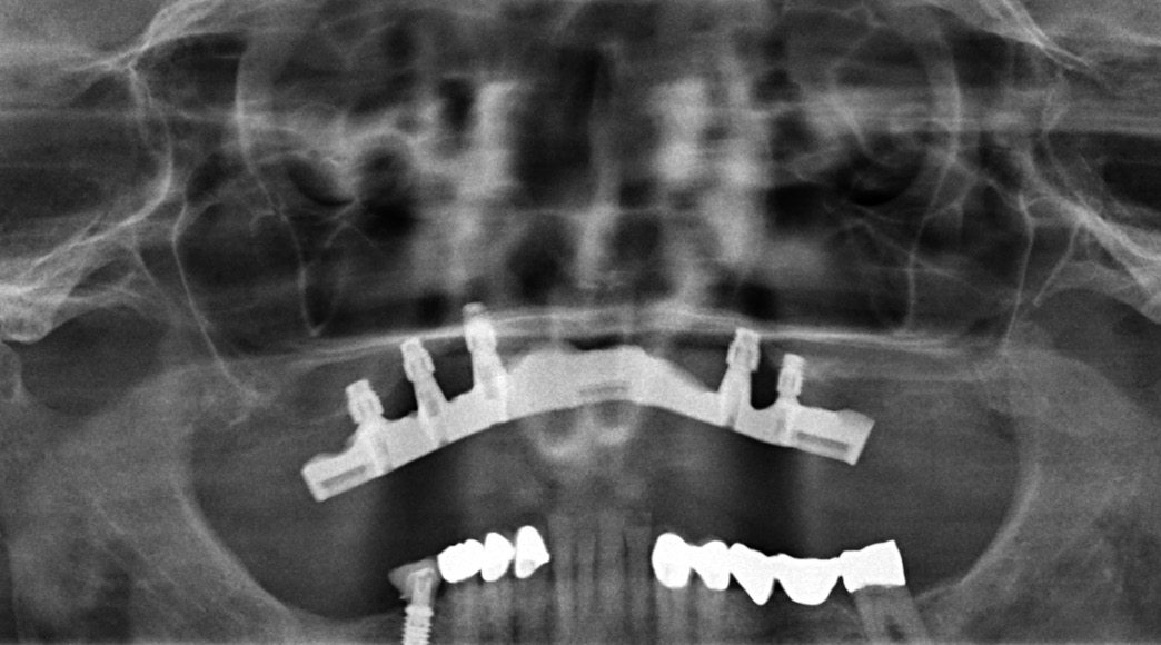 Abb. 19: Röntgenkontrolle nach Einsetzen der Suprakonstruktion (Cover-Denture).