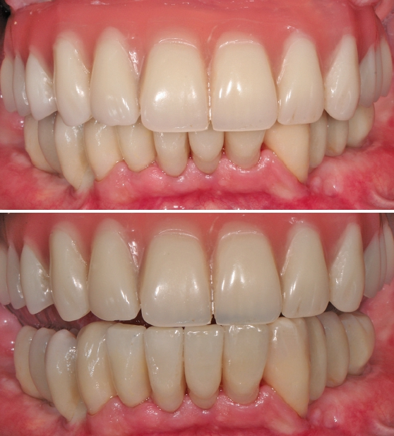 Abb. 14 a und b: Fertige Restauration eine Woche nach dem Einsetzen mit retrahierten Lippen; (a) in habitueller Okklusion und mit protrudiertem Unterkiefer (b).