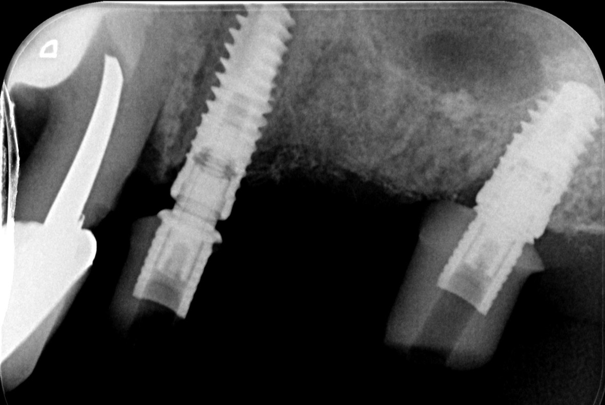 Abb. 17: Röntgenkontrollaufnahme mit eingeschraubten Abutments.