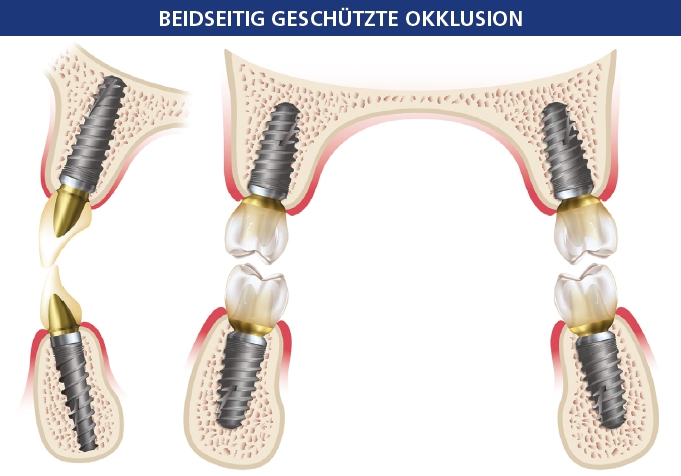 Abb. 9: Bei Bewegungen des Unterkiefers nach vorne führen die mittleren und lateralen Schneidezähne zu einer Disokklusion der posterioren Bezahnung.