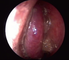 Abb. 12: Entzündliche Schleimhautschwellung mit Polyposis nasi bei allergisch-fungaler Sinusitis.