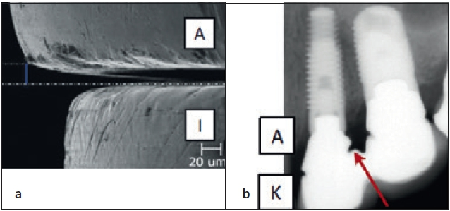 Abb. 10a u. b: Spalte zwischen Implantat (I), Aufbau (A) und Stumpfaufbau (A) und Krone (K).