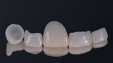 Abb. 14: Formgeschliffene Teilkronen und Veneers, hergestellt aus Hybridkeramik (Enamic).