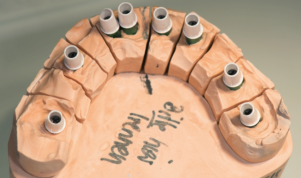Abb. 14: Aufgeschraubte Abutments auf den Laboranalogen – ohne Zahnfleischmaske.