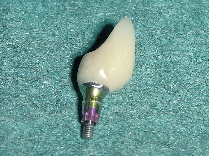 Abb. 12: Provisorische CAM-Krone.