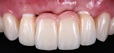 Abb. 6b: 4-gliedrige Frontzahnbrücke aus Abb. 6a bei der Einprobe auf den Implantaten 12 und 22. Die Implantatabutments sind ebenfalls wie das Brückengerüst aus Zirkoniumoxid gefertigt und wurden mit Multilink-Hybridabutment auf einer Titanbasis verklebt (Hybridabutment). Die endgültige Befestigung der Brücke erfolgte mit klassischem Glasionomerzement (Vivaglass CEM). Die Full-wrap(360°)-Veneers wurden mit Adhese Universal und Variolink Esthetic LC der Farbe „Light“ auf den Eckzähnen befestigt.