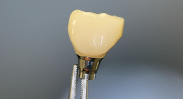 Abb. 14: Einteilige Krone, extraoral verklebt aus TelioCAD mit Astra-EV Titanbasis.