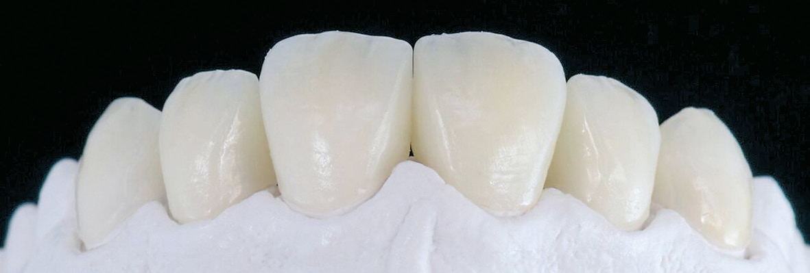 Abb. 13: Die Kontrolle auf einem ungesägten Modell zeigt den interdentalen Schluss nach Glasurbrand und manueller Politur.