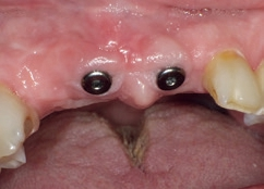 Abb. 14: Freigelegte Implantate nach 1 Woche mit schön geformtem Gingivalsaum.