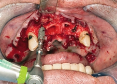 Abb. 14: Volllappen im OK, 13 und 23 zunächst belassen, Implantation regio 12.