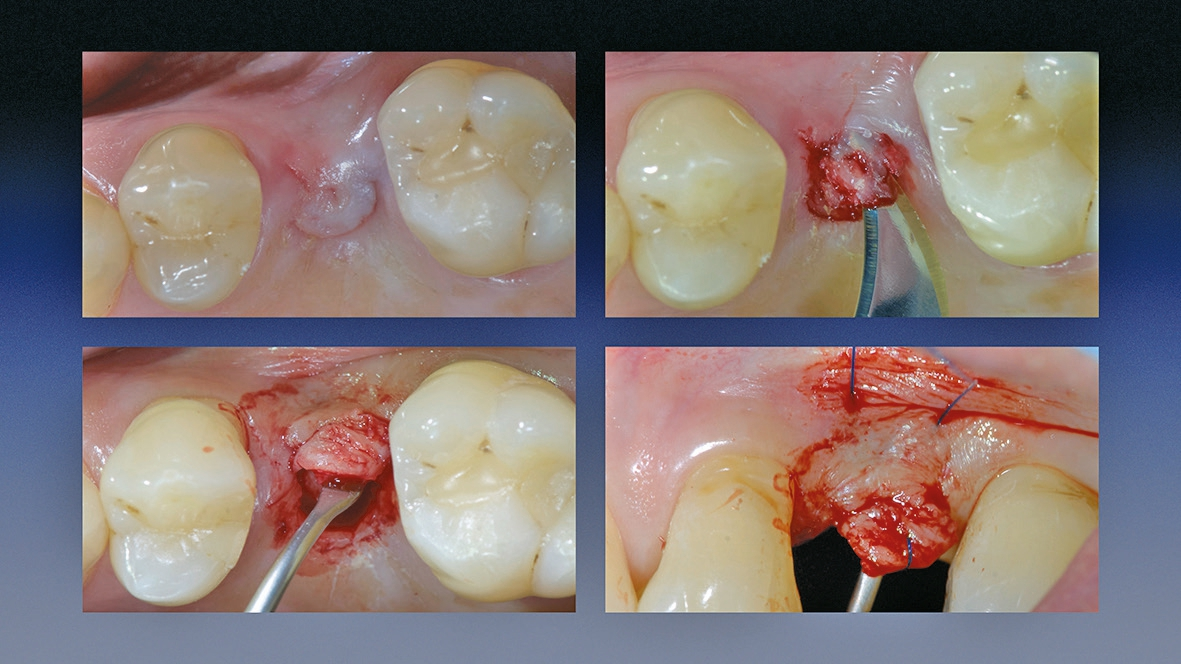 Abb. 12: Vorbereiten des Implantatbetts.