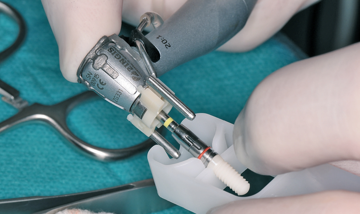 Abb. 14: Das ceramic.implant wurde mit der Eindrehhilfe aufgenommen.