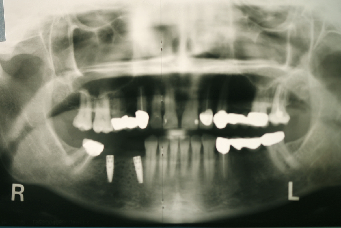 Abb. 14: Panorama-Röntgenkontrolle unmittelbar nach Implantatinsertion.