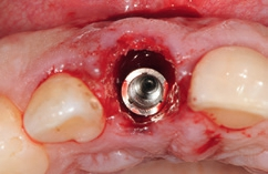 Abb. 13: Die orofaziale Position des Implantats resultiert in einem deutlichen Abstand zur bukkalen Knochenlamelle. Der Hohlraum zwischen Implantat und Knochen wird mit blutvermischtem Knochenersatzmaterial (Bio-Oss, Geistlich Biomaterials) aufgefüllt.