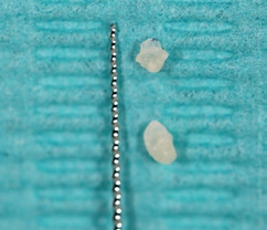 Abb. 14: Entfernte Dentikel.