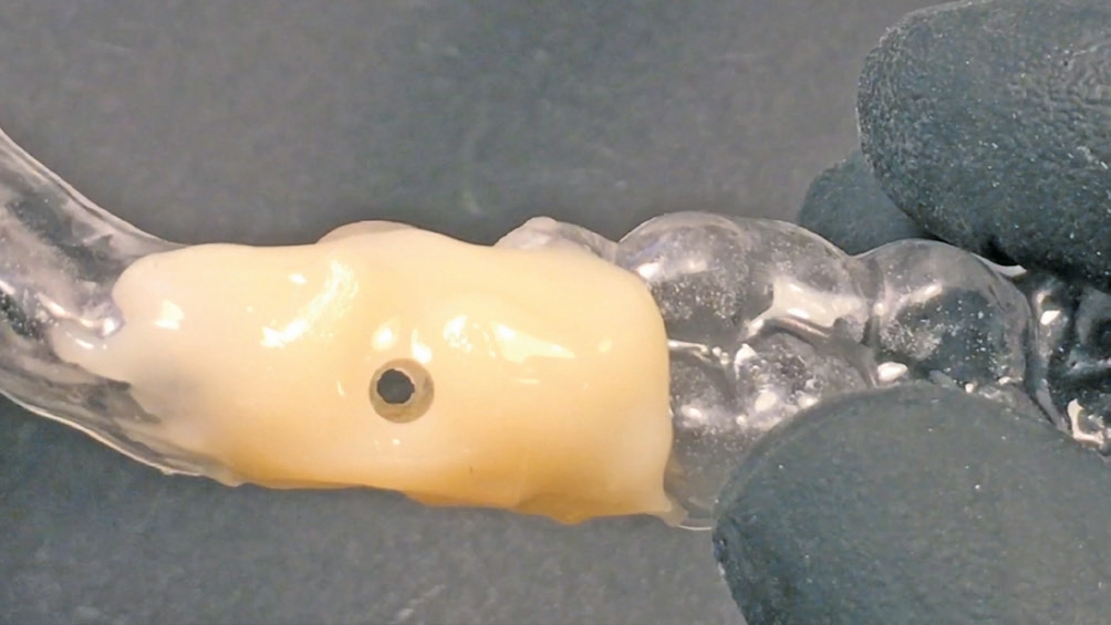 Abb. 10: Die umgearbeitete Implantat-Bohrschablone trägt den Schraubenkanal. Damit kann die Abutmentschraube erreicht und eine Schraubenlockerung bei Bedarf behoben werden.