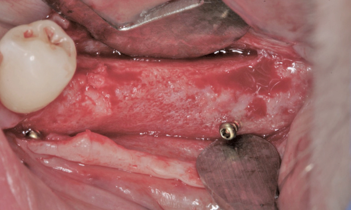 Abb. 15: Der gut revaskularisierte Knochen im Unterkiefer links. Keine erkennbare Resorption im Bereich der Fixationsschrauben.