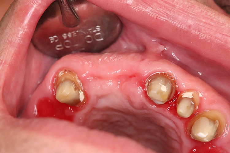 Abb. 14: Situation 3,5 Monate nach Socket Preservation im Oberkiefer.